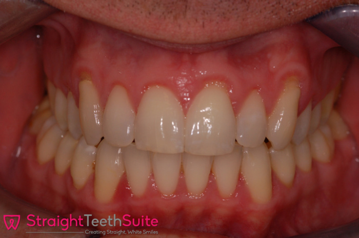 Before & After Lingual Braces in Loughborough Leicester
