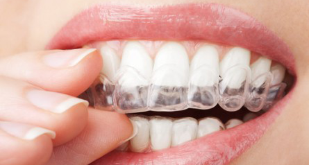 Invisalign: Straight Teeth Without Braces - image