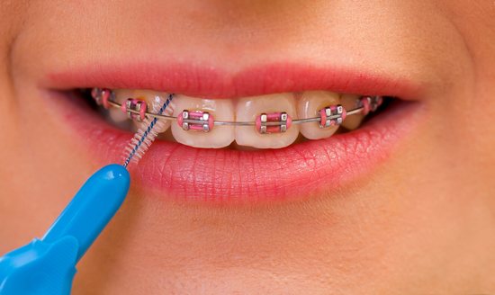 How to care for your teeth when wearing braces in Leicester - image