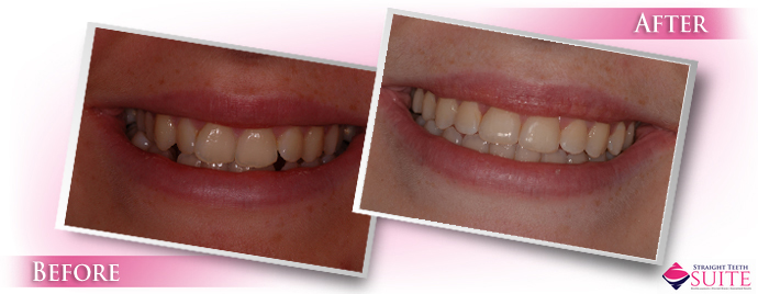 invisible-braces-straight-teeth-nottingham-leicester-loughborough-2