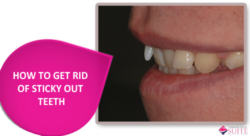 Treating sticky out teeth in Leicester - image