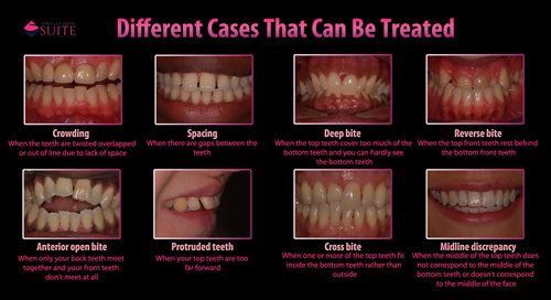 Different Cases That Can Be Treated with Dental Braces in Nottingham - image