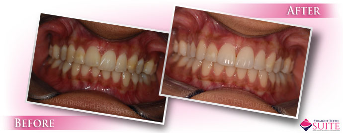 How to correct Overlapping Front Teeth with dental braces in Nottingham - image