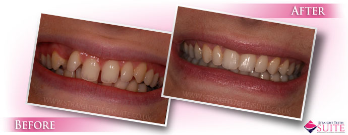 What if you are not eligible for 6 months braces in Loughborough? - image