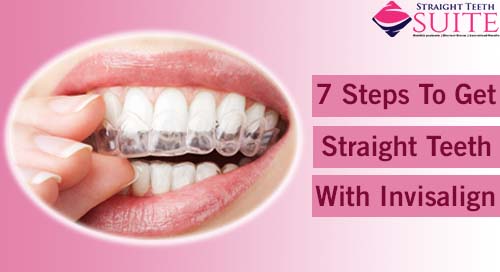 What Is Invisalign and How are the Appointments Structured in Nottingham? - image